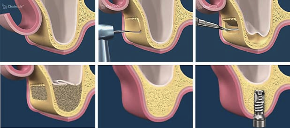 Sinus lift