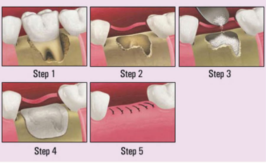 Healing Process After Dental Bone Graft at Bernadine Trombley blog