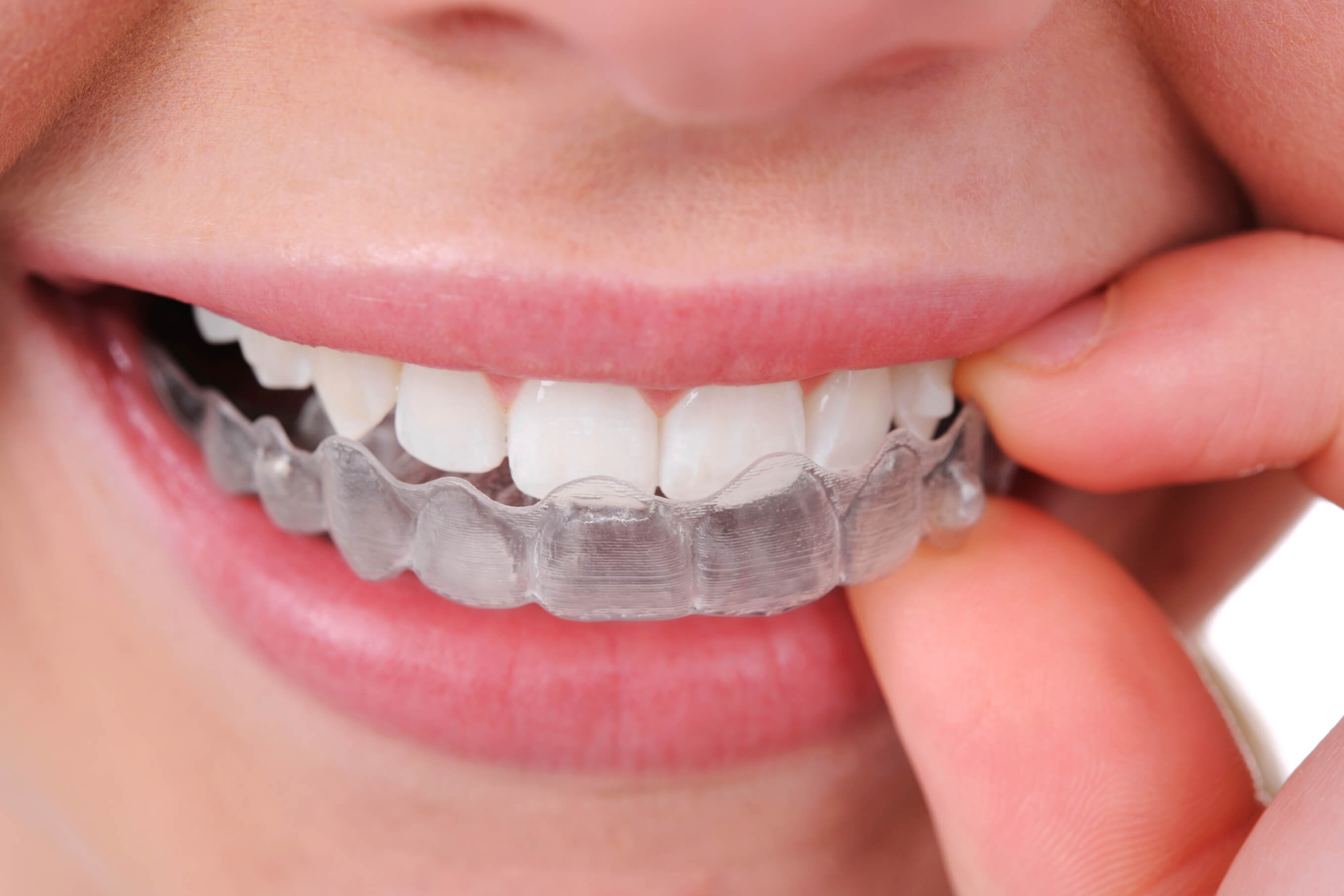 Invisalign-Bronte Village Dental is your one stop for your dental needs